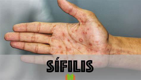 sifilis simptomi